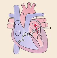 Während der Systole strömt Blut „rückwärts“ (Pfeil) durch die Mitral-klappe vom linken Ventrikel in den linken Vorhof. 1 Mitralklappe, 2 L. Ventrikel 3 Linker Vorhof, 4 Aorta Quelle: wikipedia.org